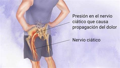Ilustración que muestra el recorrido del nervio ciático y posibles puntos de compresión.