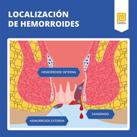 Ilustración anatómica del ano y recto mostrando hemorroides internas y externas