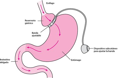 Esquema anatómico mostrando la colocación de la banda gástrica alrededor del estómago.