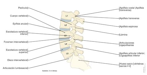 Diagrama anatómico de la columna vertebral mostrando el deslizamiento de una vértebra en el contexto de la espondilolistesis.