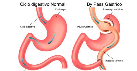 Esquema comparativo del estómago antes y después de un bypass gástrico, mostrando la bolsa gástrica y la derivación intestinal.