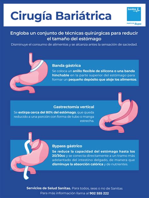 Infografía que muestra la reducción del estómago en forma de manga durante la gastrectomía vertical.