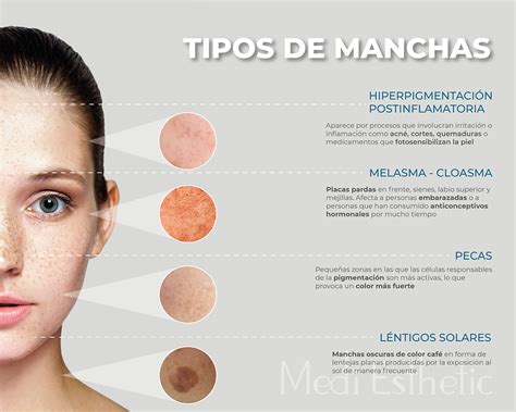 Ilustración comparativa de diferentes tipos de manchas en la piel: léntigo solar, melasma, hiperpigmentación postinflamatoria.