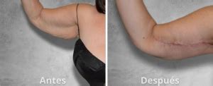 fotografía de antes y después de una liposucción de brazos