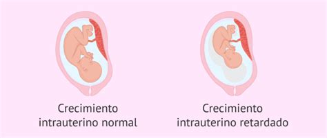 Infografía comparando crecimiento prenatal normal, retraso de crecimiento intrauterino y PEG