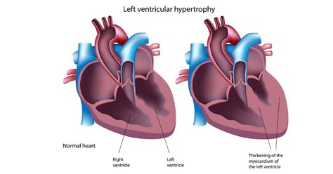 diagrama del corazón humano mostrando la hipertrofia del ventrículo izquierdo