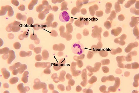 Microfotografía de un frotis de sangre periférica mostrando siderocitos (cuerpos de Pappenheimer)