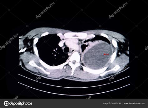 Tomografía axial computarizada de tórax mostrando múltiples nódulos cavitados.