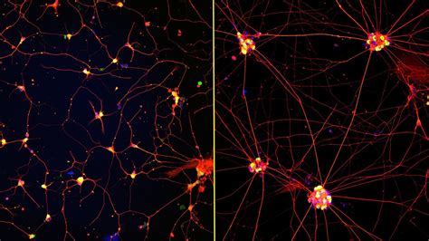 Representación artística de neuronas humanas generadas en laboratorio a partir de células de la piel de un paciente con Alzheimer.