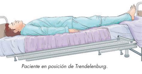 Ilustración de la posición Trendelenburg con énfasis en la inclinación de la mesa