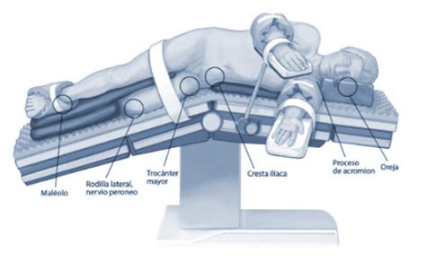Ilustración de un paciente en posición lateral derecha para cirugía