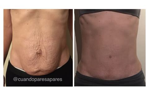 Comparativa visual antes y después de una abdominoplastia, mostrando la eliminación del exceso de piel y la tonificación abdominal.