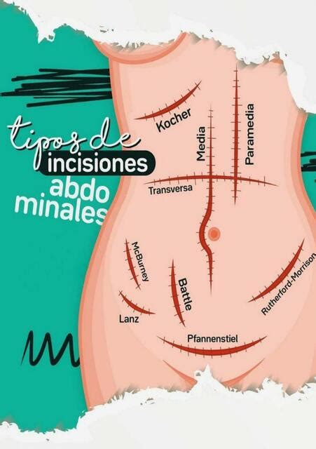 Ilustración médica mostrando diferentes tipos de incisiones para una abdominoplastia.