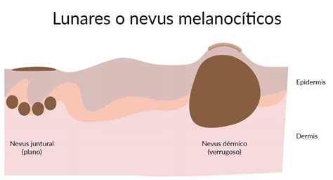 Ilustración comparativa de un nevus benigno y un nevus atípico, destacando diferencias en simetría, bordes y coloración.