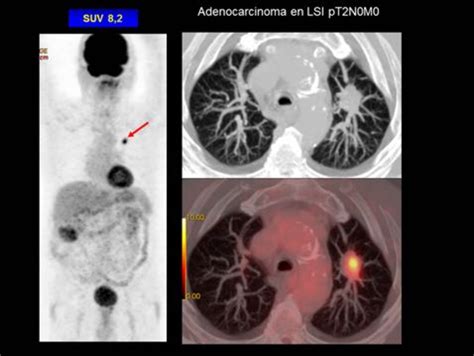Imagen PET-TC mostrando un nódulo pulmonar con alta captación de FDG, indicativo de posible malignidad.