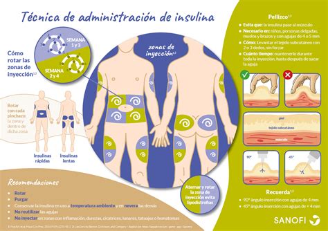 Infografía mostrando cómo rotar los puntos de inyección dentro de cada zona (abdomen, muslo, brazo) para evitar la lipohipertrofia.